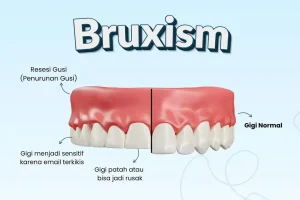 Bruxism Saat Tidur: Rahang Pegal dan Gigi Sensitif